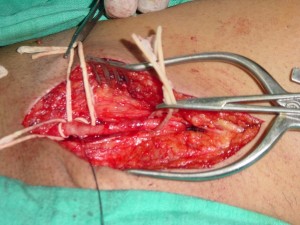Vessels Exposed For Femoral Embolectomy