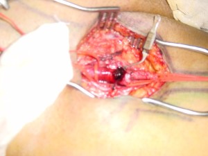 Embolectomy Rt CFA