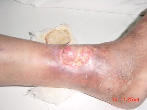 Neglected Venous Ulcer