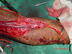 Reverse LSV Bypass – Lower End Anastamosis