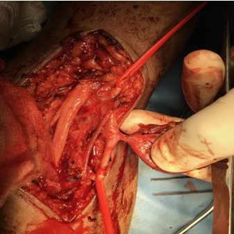 dilated artery isolated